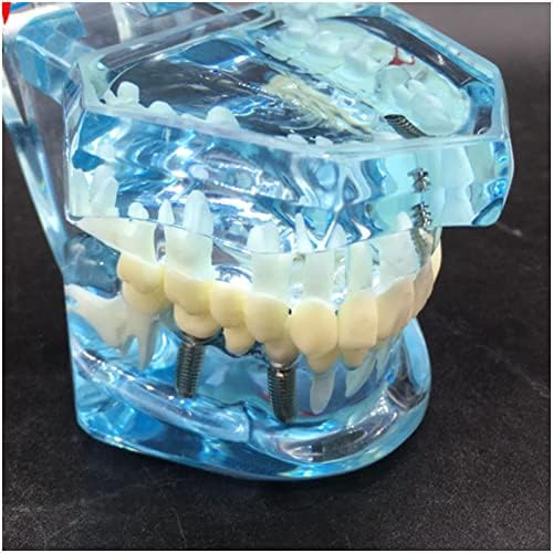 KH66ZKY Crystal Patološki model zuba - Model obnove implantata - za djecu u nastavi, stomatologu, studente zuba, alat za